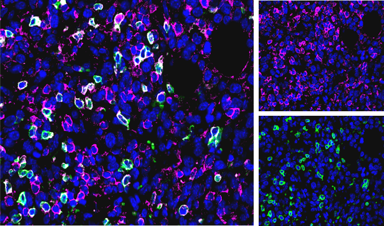 图1：CT26肿瘤中的CD3（粉色）、CD4（绿色）和DAPI（蓝色）染色。