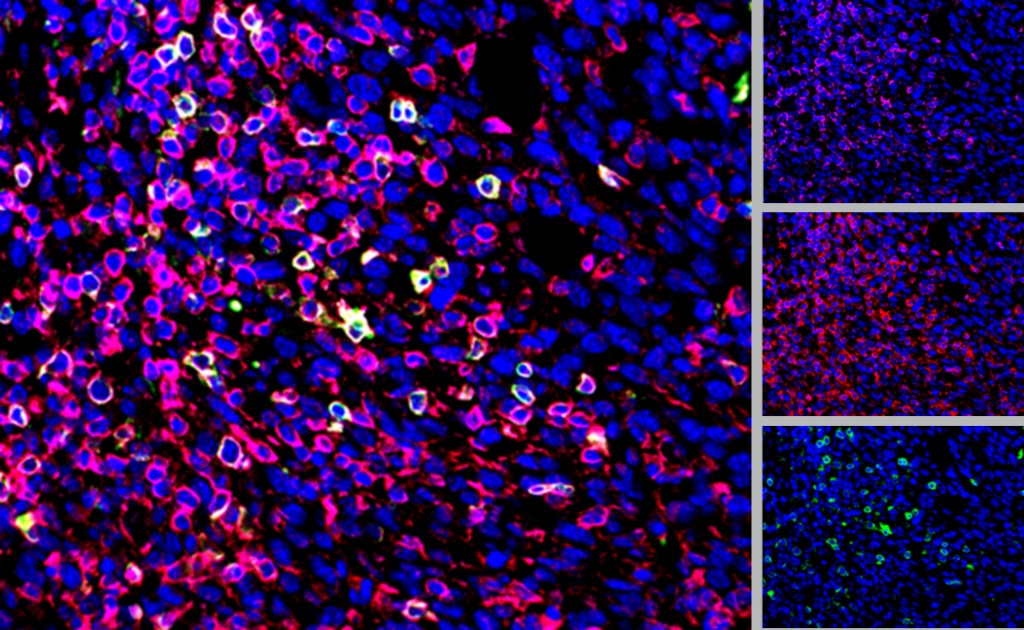 Fig. 2 : Coloration d'une tumeur CT26 CD3 (rose), CD4 (vert), CD45 (rouge) et DAPI (bleu).